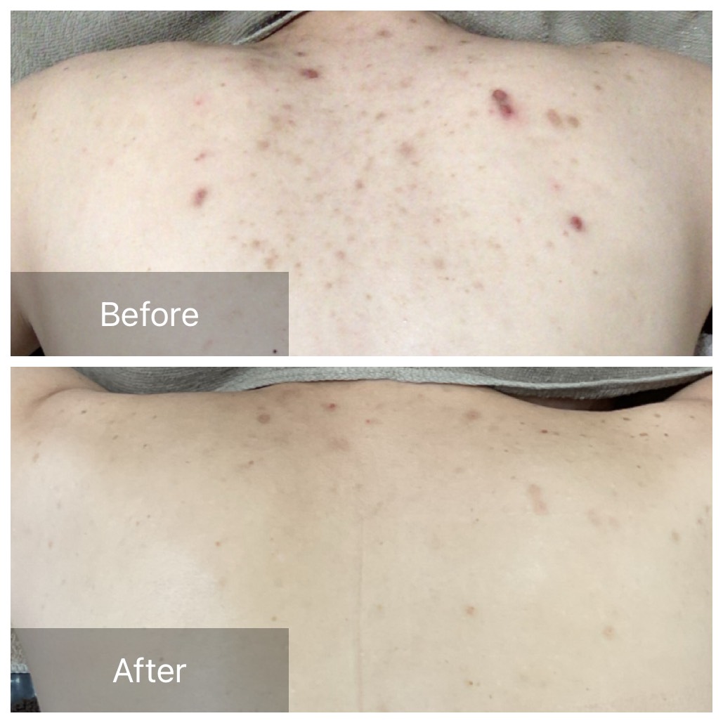 背中ニキビの改善事例
