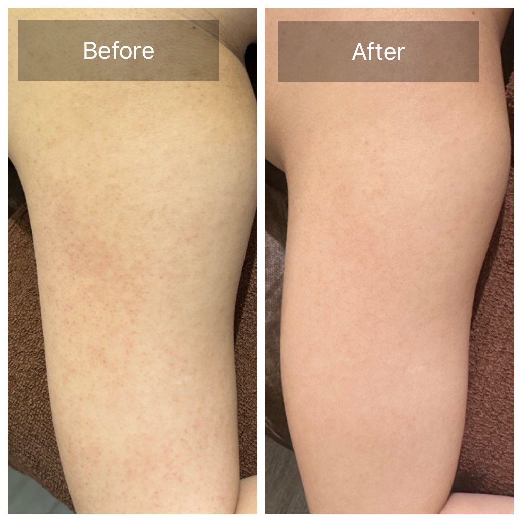 二の腕の施術事例